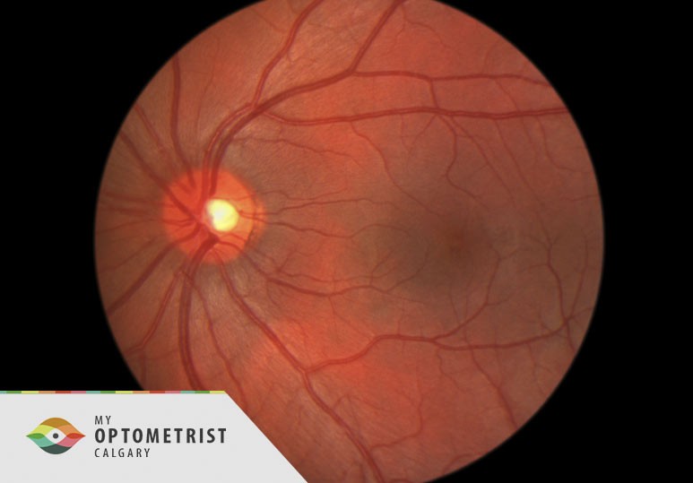 Diabetic Retinopathy: What It Is and How to Prevent It