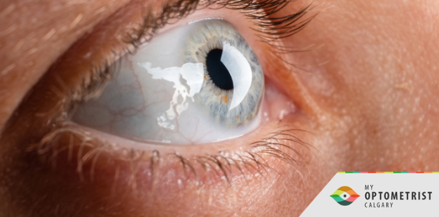 What are Corneal Diseases? 3 Signs You Need an Eye Exam ASAP 