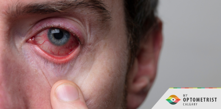 How to Stop the Spread of Pink Eye in Your Household 