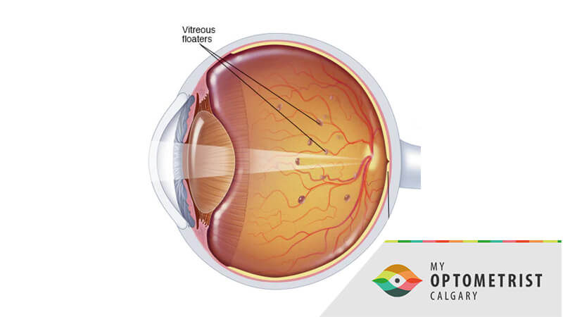 vitreous syneresis treatment