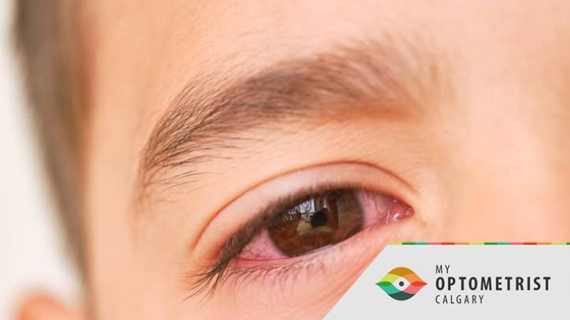How Does An Eye Doctor Treat Conjunctivitis (Pink Eye)?