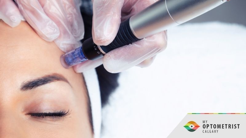 Morpheus8 for Red & Brown Spots: How It Restores Clear, Even Skin