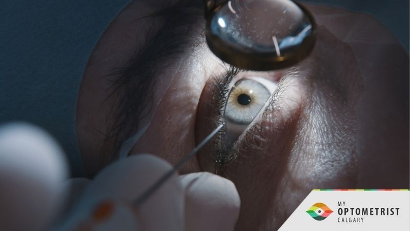 Common Cataract Myths That Might Surprise You