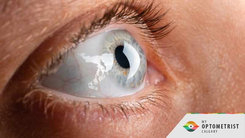 What are Corneal Diseases? 3 Signs You Need an Eye Exam ASAP 