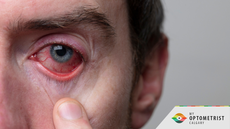 How to Stop the Spread of Pink Eye in Your Household 