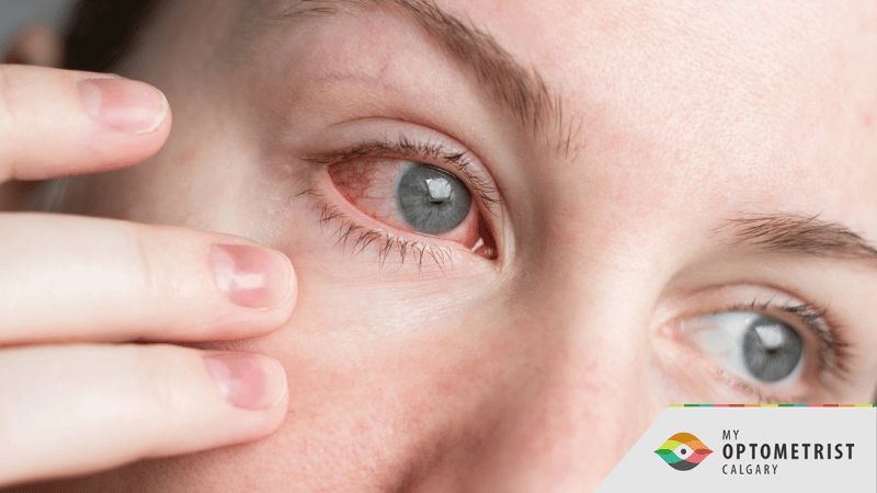 Eye Emergency vs Eye Irritation: When Should You Worry?